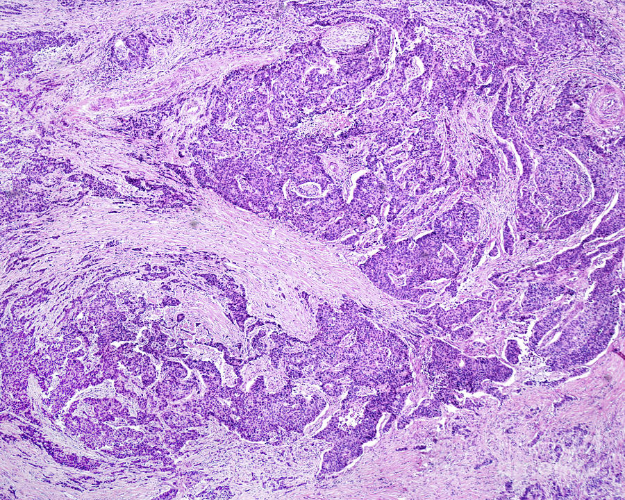 Gastric Adenocarcinoma #2 Photograph by Jose Calvo / Science Photo Library