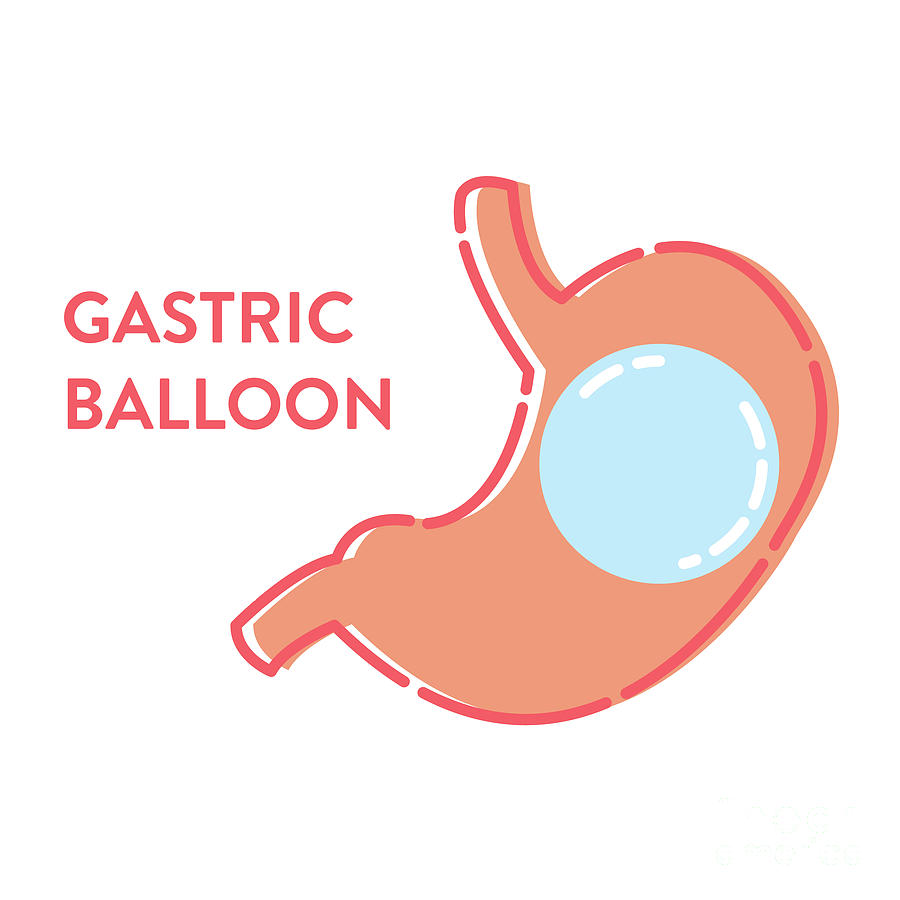 gastric-balloon-photograph-by-art4stock-science-photo-library-pixels