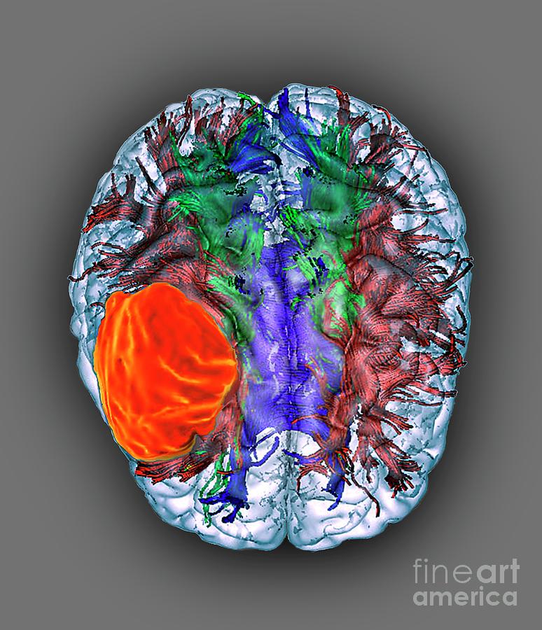 Glioblastoma Brain Cancer #2 Photograph by Zephyr/science Photo Library