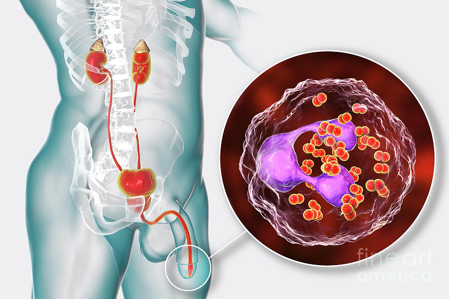 Gonorrhoea Infection In Male Photograph By Kateryna Kon Science Photo