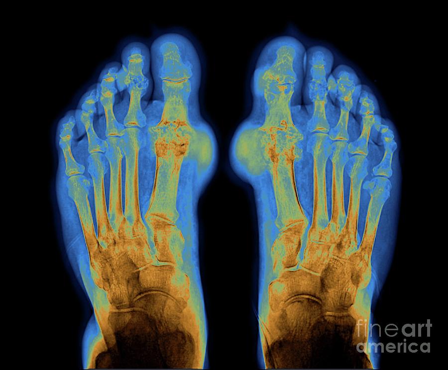 Gout #2 Photograph by Zephyr/science Photo Library