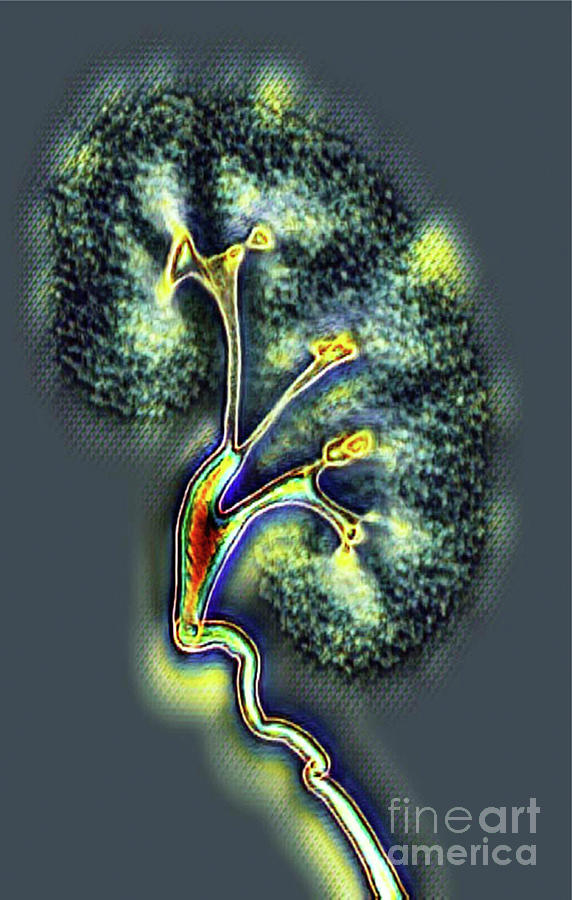 Healthy Kidney Photograph by Vsevolod Zviryk/science Photo Library ...