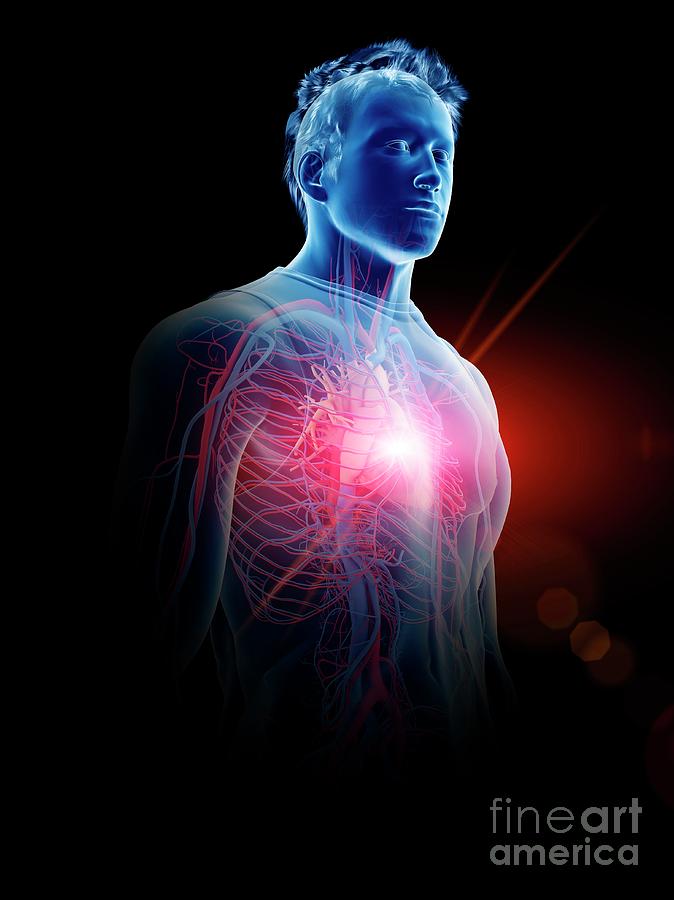 3d Photograph - Heart Disease #2 by Sebastian Kaulitzki/science Photo Library