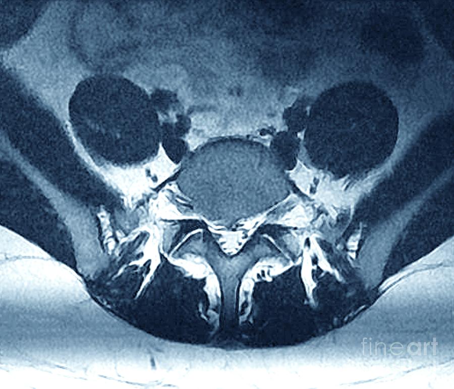 Herniated Disk In Sciatica #2 Photograph by Zephyr/science Photo ...