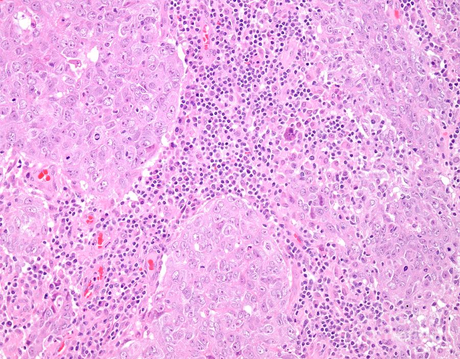 High Grade Invasive Ductal Breast Cancer Photograph By Webpathology