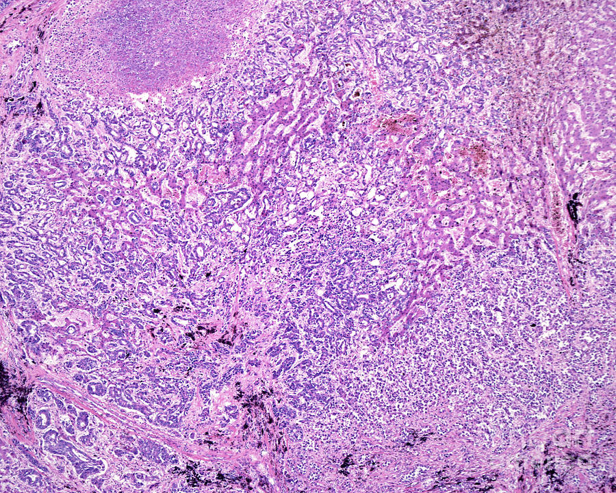 Human Liver Carcinoma Photograph By Jose Calvo   Science Photo Library 