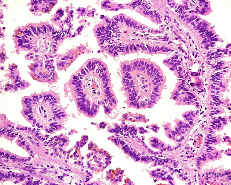 Human Renal Cell Carcinoma #2 Photograph by Science Photo Library - Pixels