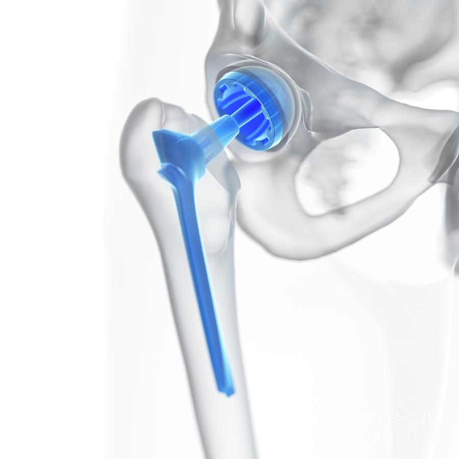 Illustration Of A Hip Replacement Photograph by Sebastian Kaulitzki ...