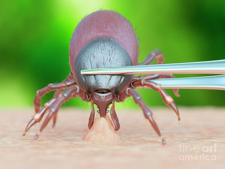 Nature Photograph - Illustration Of A Tick Being Removed #2 by Sebastian Kaulitzki/science Photo Library