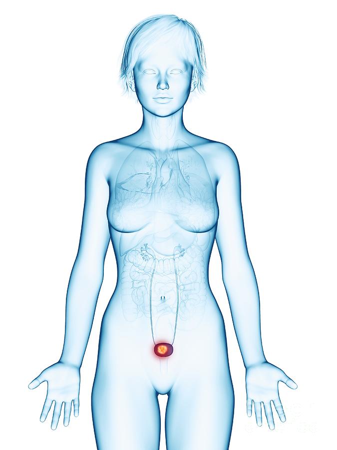 3d Photograph - Illustration Of Bladder Cancer #2 by Sebastian Kaulitzki/science Photo Library