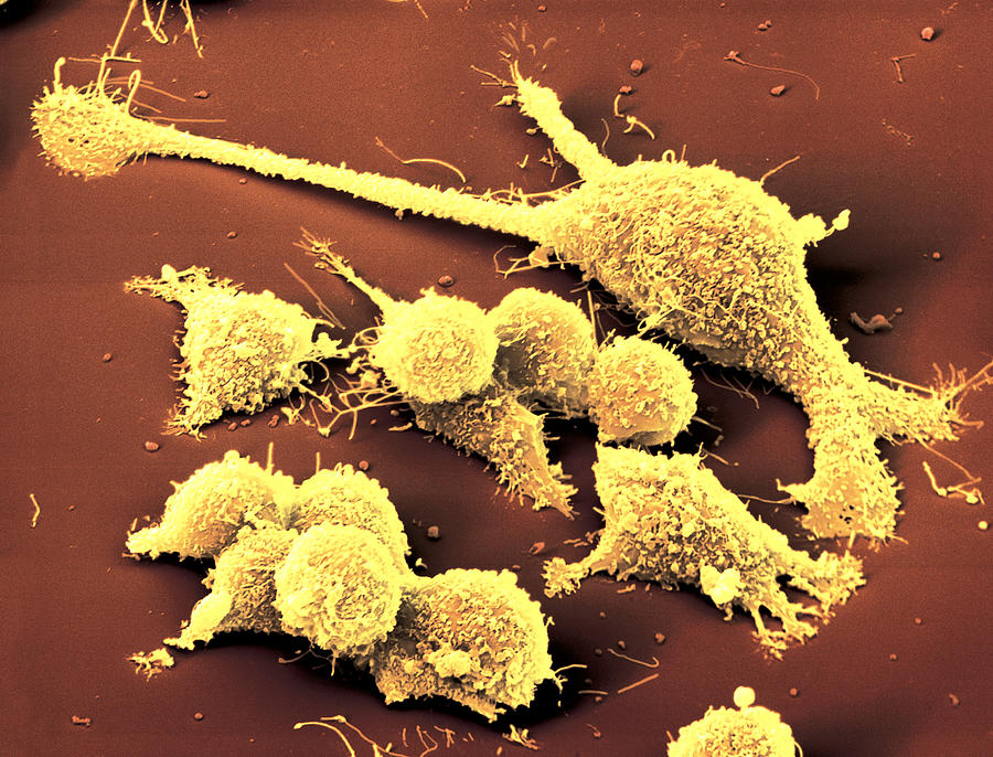 Intestinal Cancer Cells #2 Photograph by Meckes/ottawa