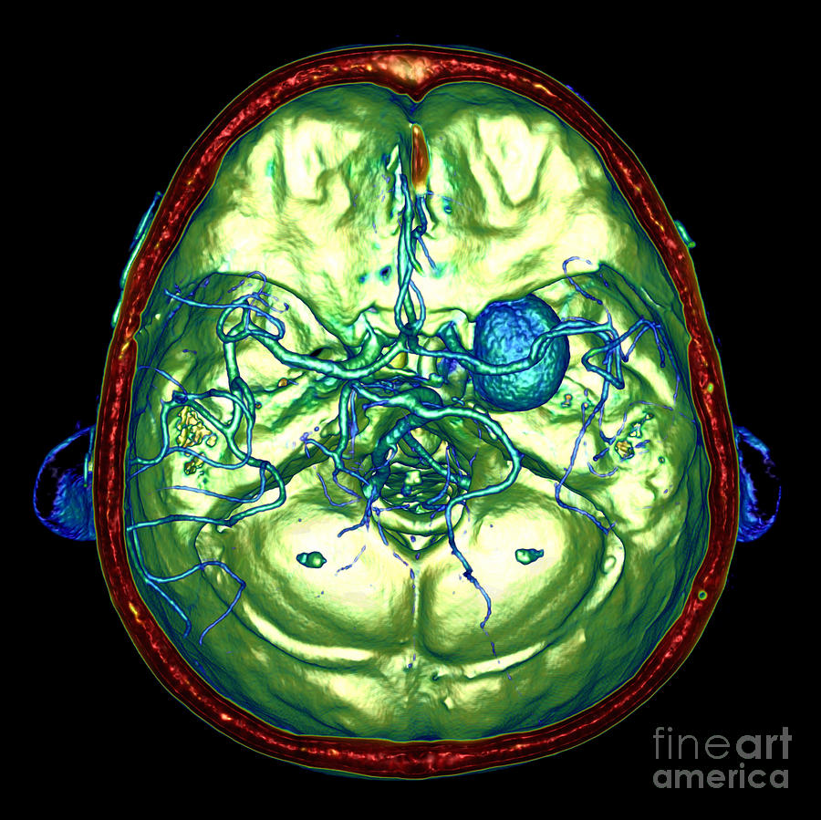 Intracranial Aneurysm #2 by Vsevolod Zviryk/science Photo Library