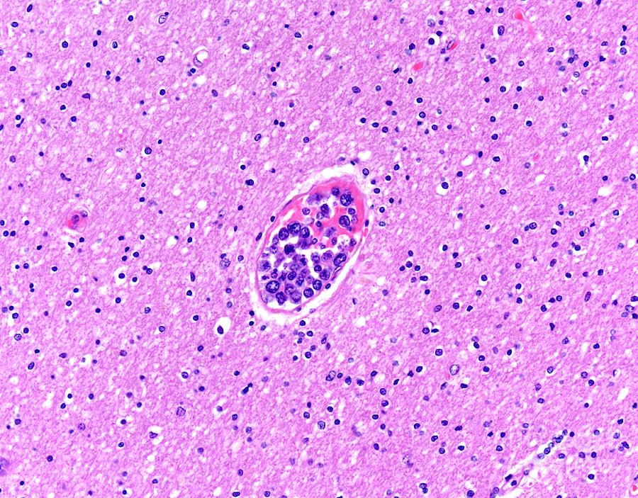 Intravascular Large B-cell Lymphoma Photograph By Webpathology/science ...