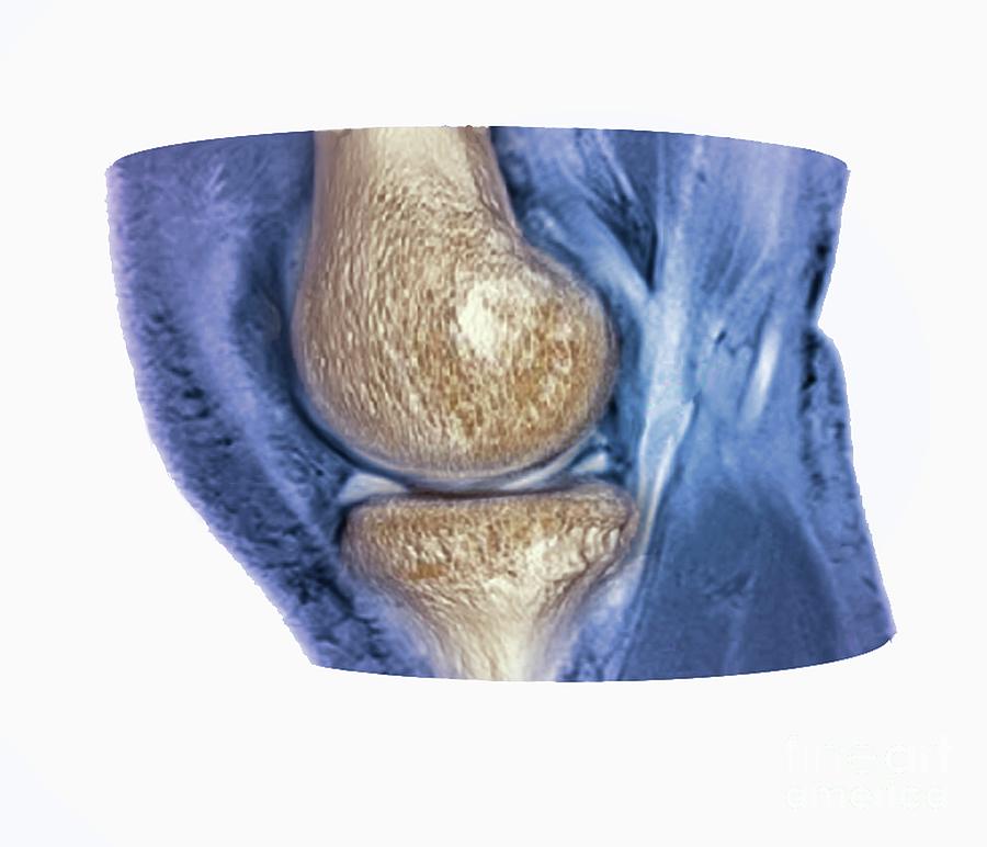 Knee Meniscus Injury Photograph By Zephyrscience Photo Library Fine