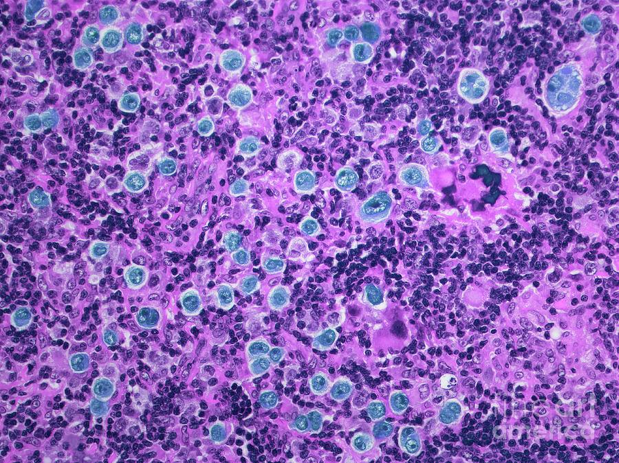 Large B Cell Lymphoma #2 Photograph by Steve Gschmeissner/science Photo Library