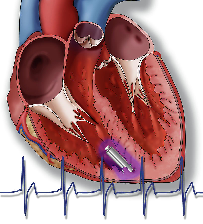 Leadless Pacemaker Illustration Photograph By Monica Schroeder Pixels