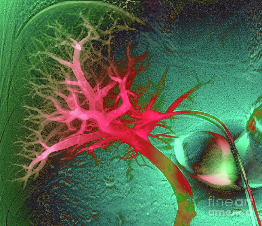 Liver Blood Vessels Photograph by Zephyr/science Photo Library - Fine ...