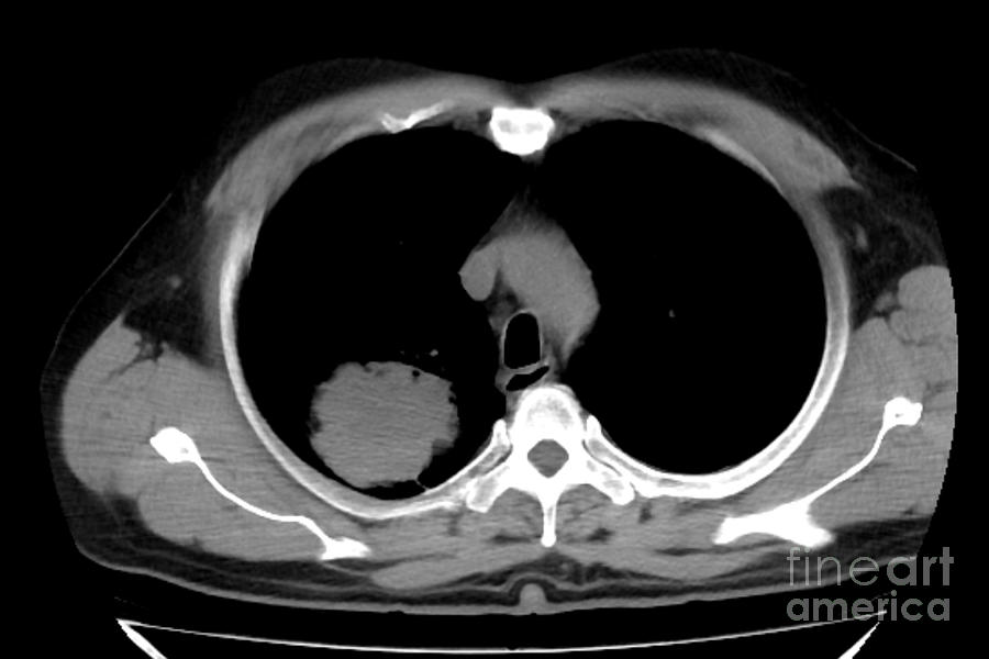 Lung Carcinoma Photograph by Rajaaisya/science Photo Library | Fine Art ...