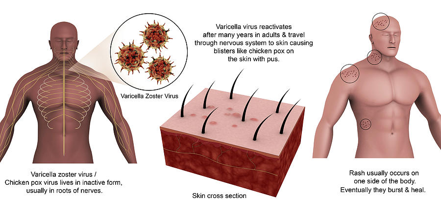 Medical Diagram Showing Shingles Caused #2 Photograph by Stocktrek Images