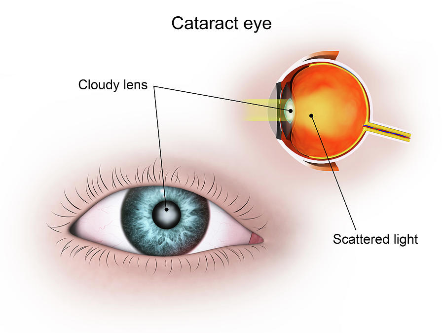 Medical Illustration Of A Cataract #2 Photograph by Stocktrek Images