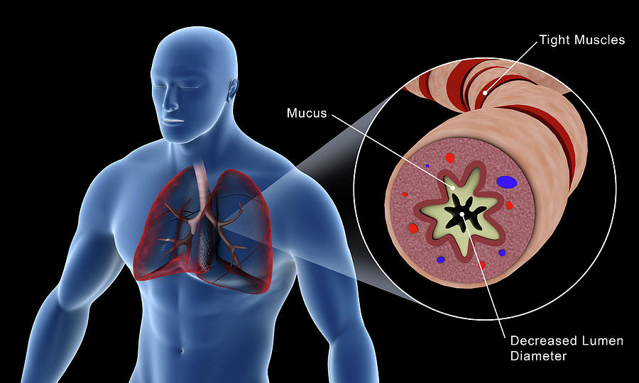 Medical Illustration Of An Asthmatic #2 Photograph by Stocktrek Images