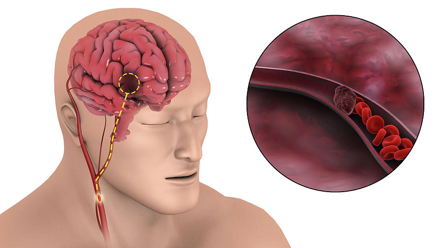 Medical Illustration Of An Ischemic #2 Photograph by Stocktrek Images