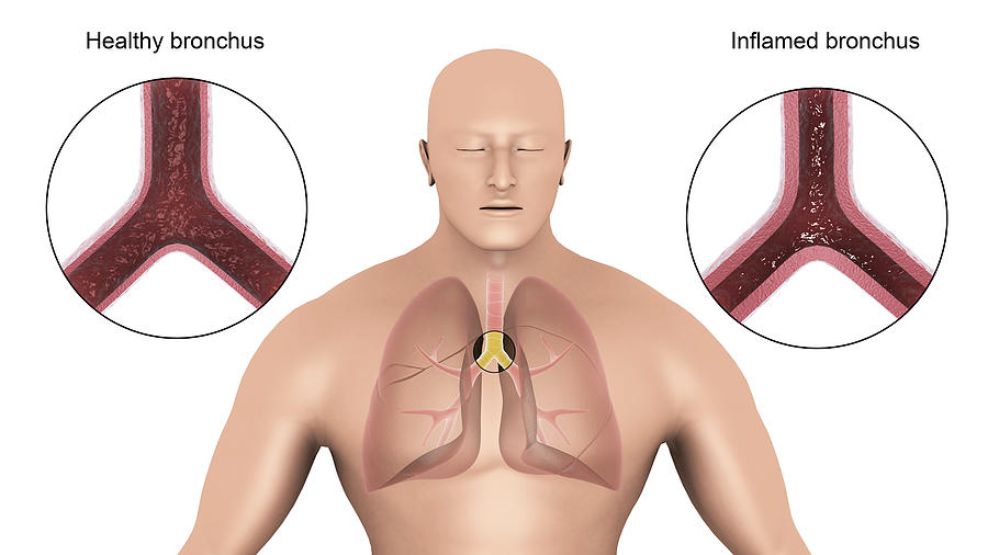 Medical Illustration Showing Bronchitis #2 Photograph by Stocktrek Images