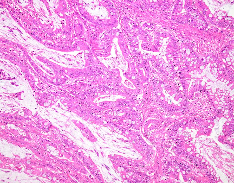 Mucinous Carcinoma Of The Colon Photograph by Webpathology/science ...