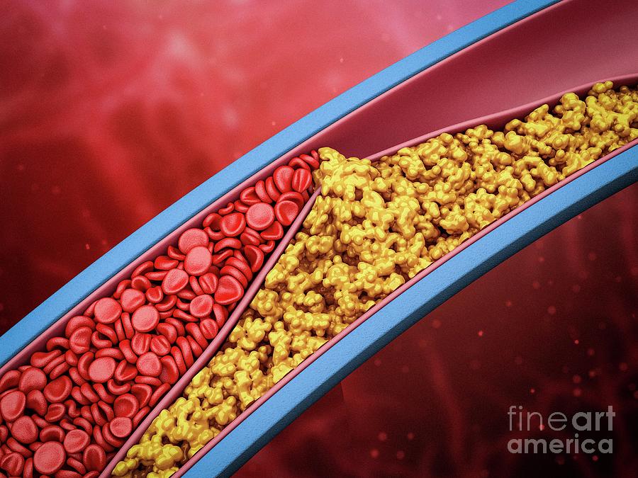 Narrowed Artery #2 Photograph by Maurizio De Angelis/science Photo Library