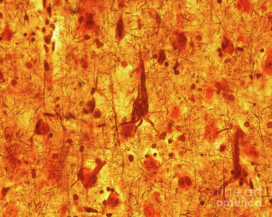 Neurofibrillary Tangles #2 Photograph by Jose Calvo / Science Photo Library
