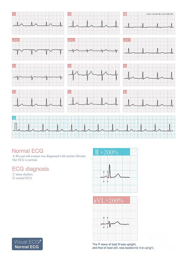 electrocardiograma normal