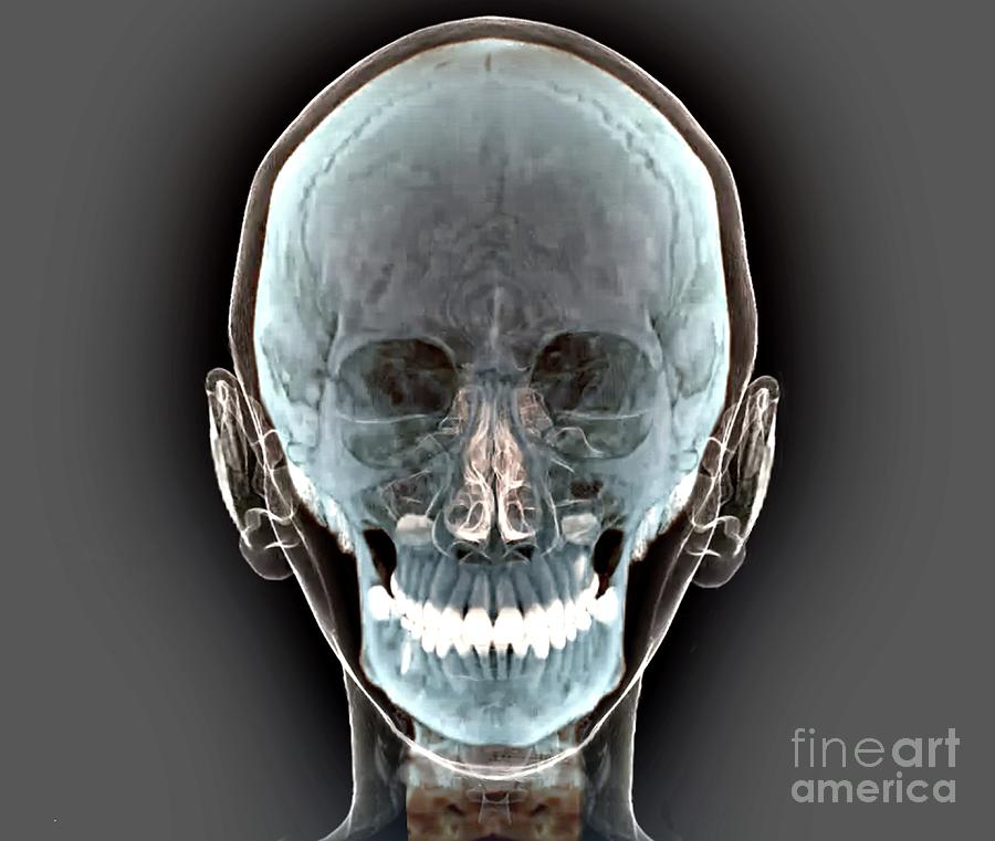 Normal Human Skull Photograph by Zephyr/science Photo Library - Fine ...