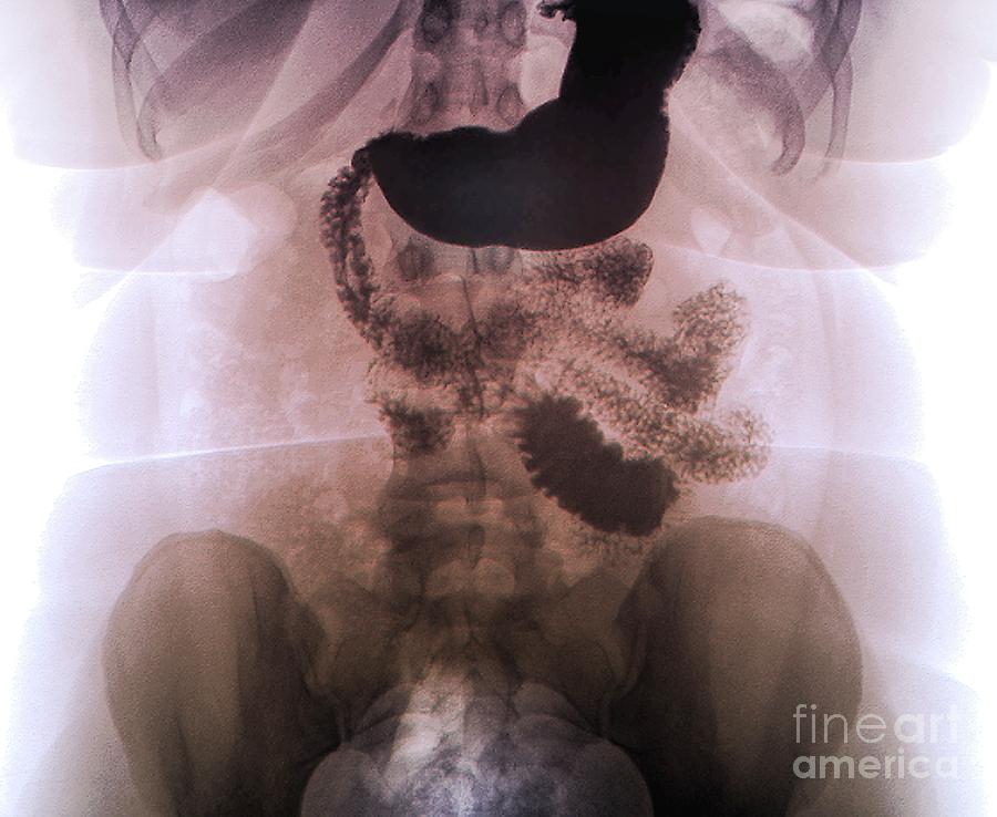 Oeso-gastrointestinal Duodenal Transit #2 Photograph by Zephyr/science Photo Library