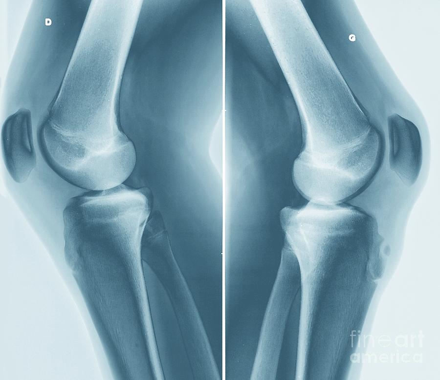 Osgood-schlatter Disease #2 Photograph by Zephyr/science Photo Library