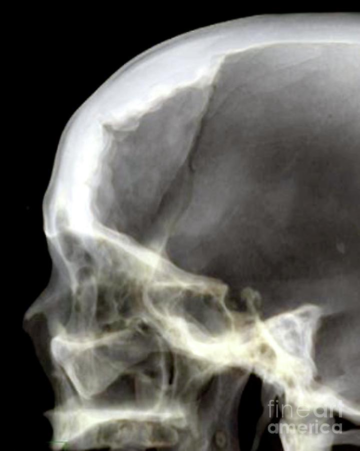 Osteoma Photograph by Zephyr/science Photo Library - Fine Art America