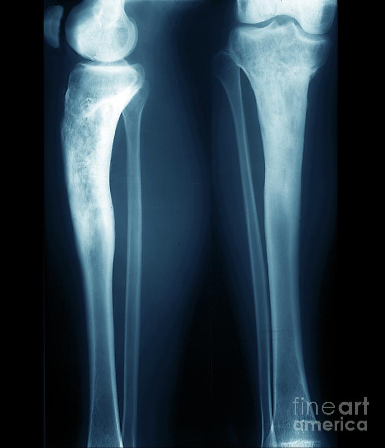 Bones Of The Lower Leg - Health Library