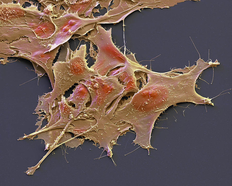Ovarian Cancer Cells In Culture, Sem #2 Photograph by Meckes/ottawa