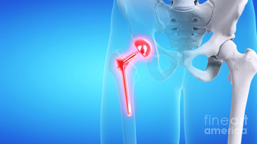 Painful Hip Replacement #2 Photograph by Sebastian Kaulitzki/science Photo Library