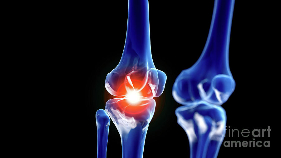 Painful Knee Joint #2 Photograph by Sebastian Kaulitzki/science Photo Library
