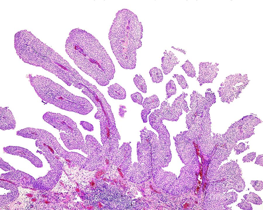 Papillary Carcinoma Of Bladder #2 Photograph by Jose Calvo / Science Photo Library