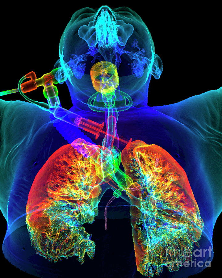 Patient With Tracheostomy On Ventilator #2 Photograph by K H Fung/science Photo Library