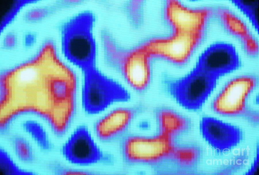 Pet Scan (temporal) Of Carbon Monoxide Poisoning #2 Photograph by Tim Beddow/science Photo Library