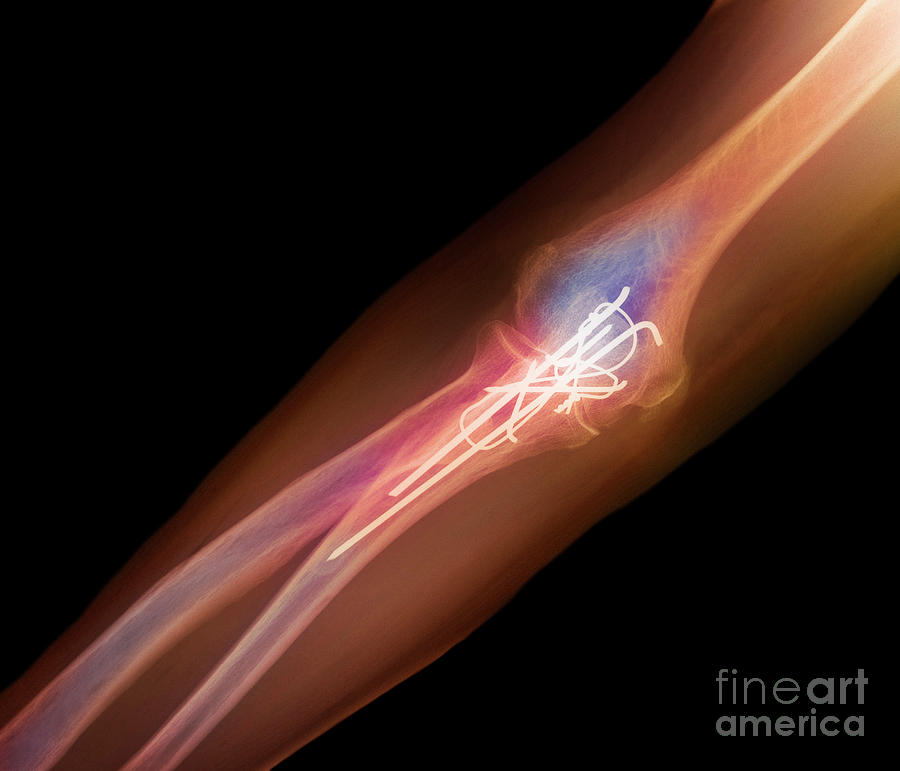 Pinned Elbow Fracture X-ray #2 Photograph by Science Photo Library Pinned Elbow Fracture X-ray #2 Photograph by Science Photo Library