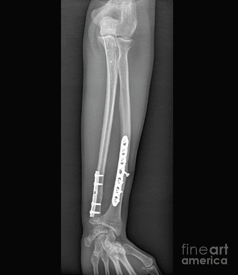 Pinned Fractured Lower Arm Bones Photograph By Zephyrscience Photo Library Pixels 9865