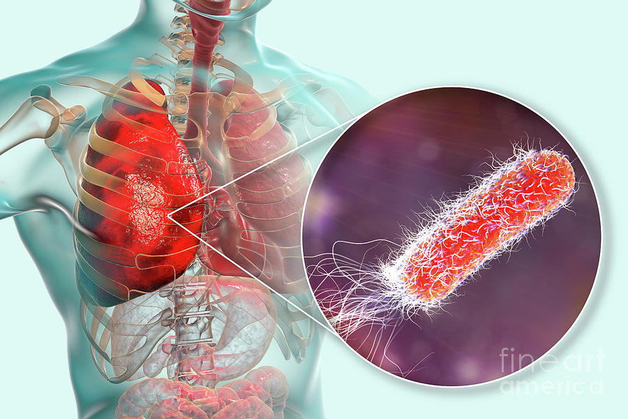 Pneumonia Caused By Moraxella Catarrhalis Photograph By Kateryna Kon Science Photo Library