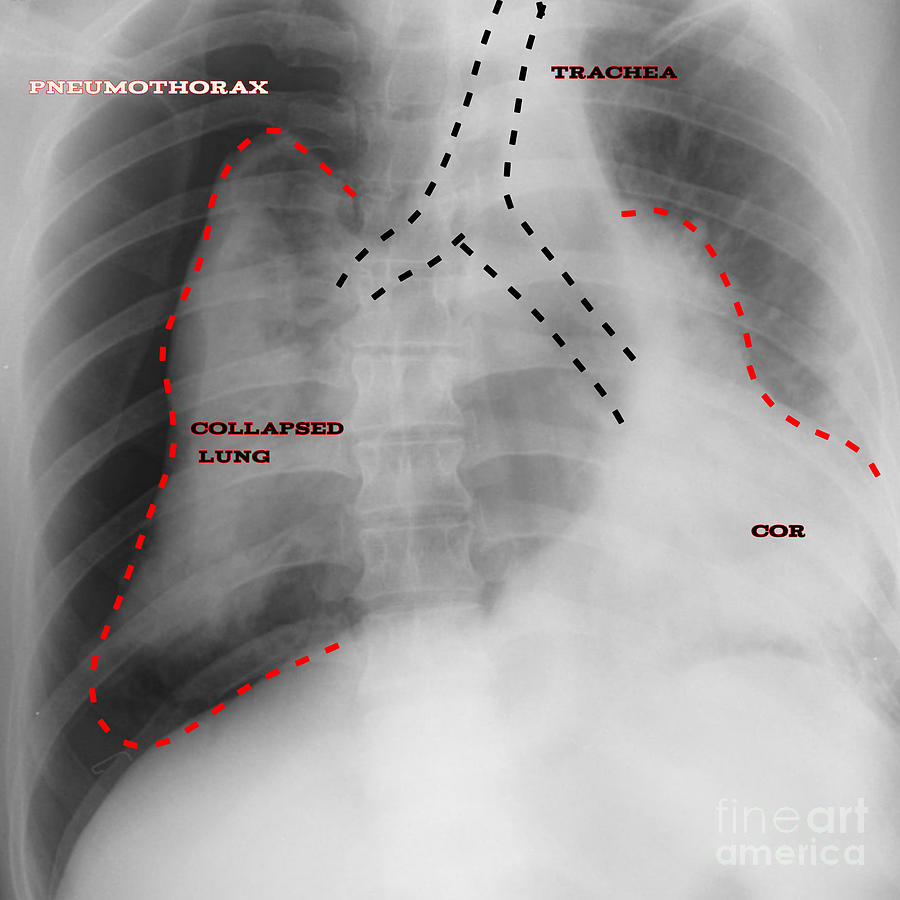 Pneumothorax #2 Photograph by Rajaaisya/science Photo Library