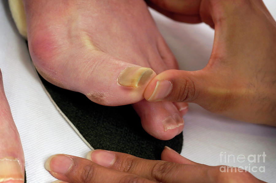Podiatry Treatment #2 Photograph by Medicimage / Science Photo Library