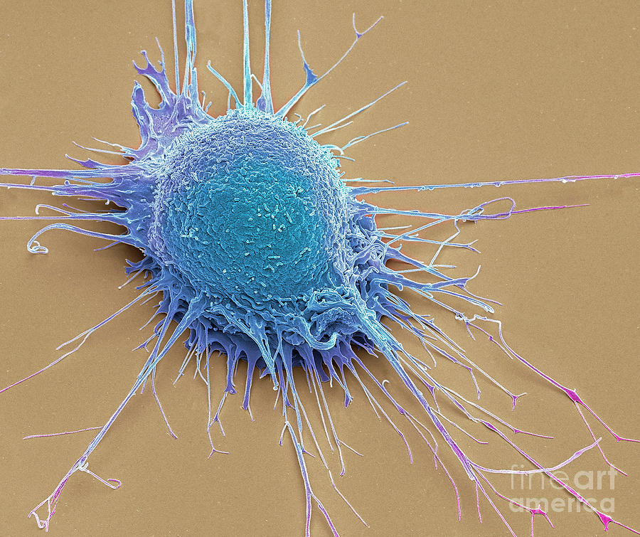 Prostate Cancer Cell Photograph by Steve Gschmeissner/science Photo ...