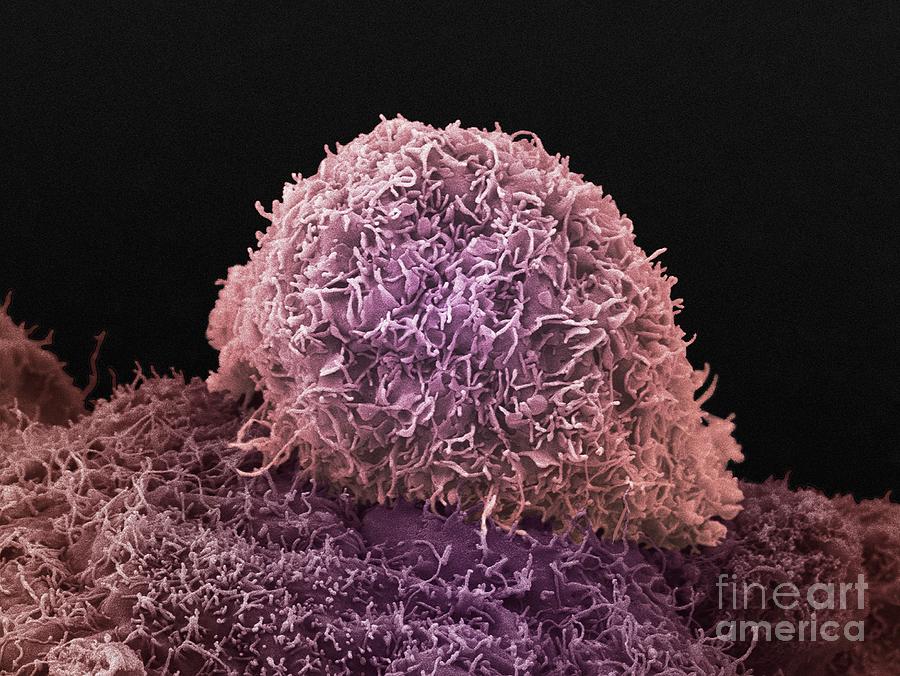 Prostate Cancer Cells Photograph By Anne Weston Francis Crick Institutescience Photo Library 9143