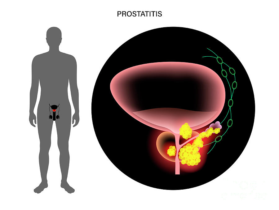 Prostate Cancer Photograph by Pikovit / Science Photo Library - Fine ...